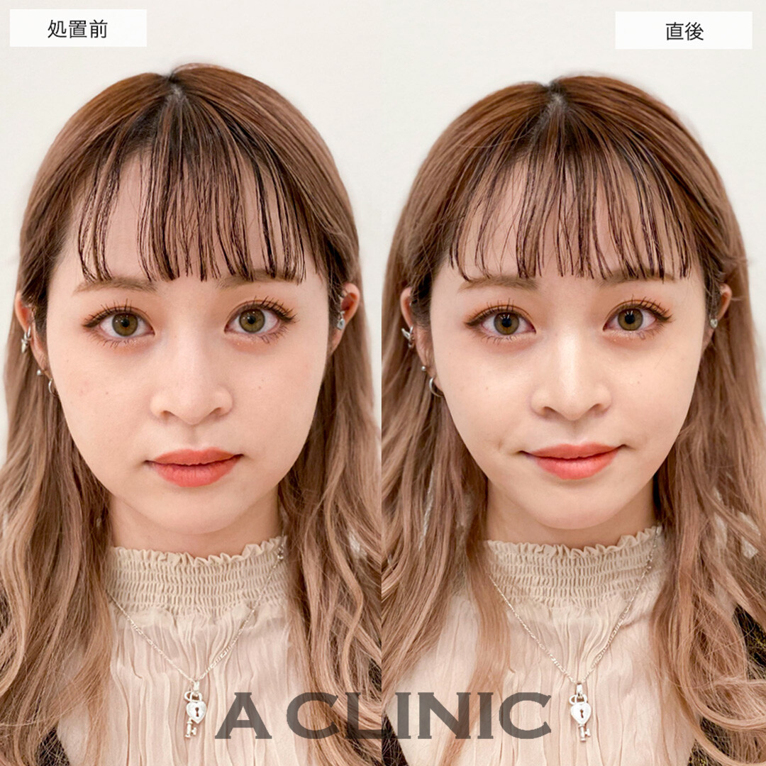 Aスレッドでたるみ解消し垢抜けた印象に!こちら処置前と直後の症例です(20代女性)