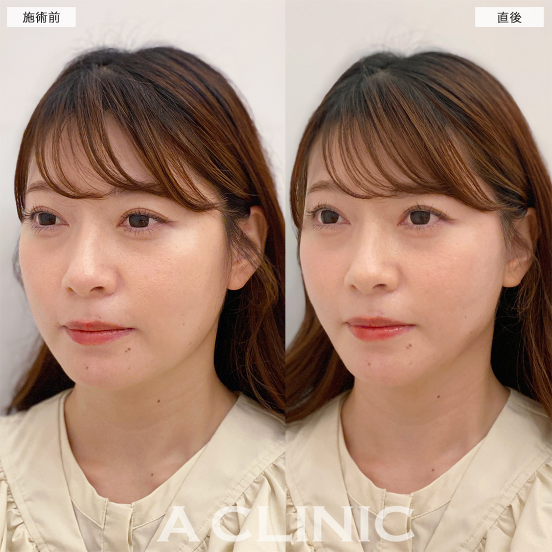 Aスレッドは人中短縮にも効果あり！こちら処置前と直後の症例です(30代女性)