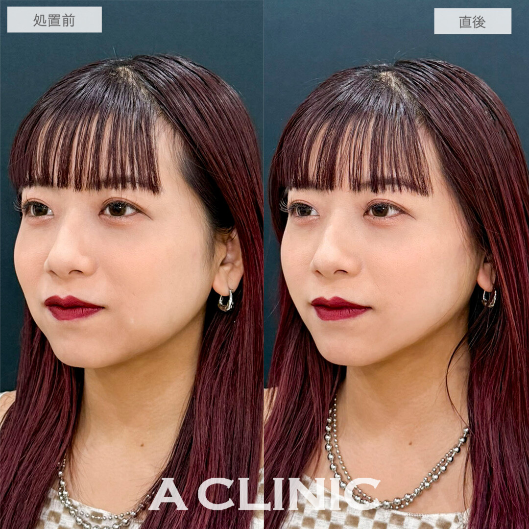 Aスレッドで口横のもたつきと左右差が解消して輪郭が整いました！処置前と直後の症例です(20代女性)
