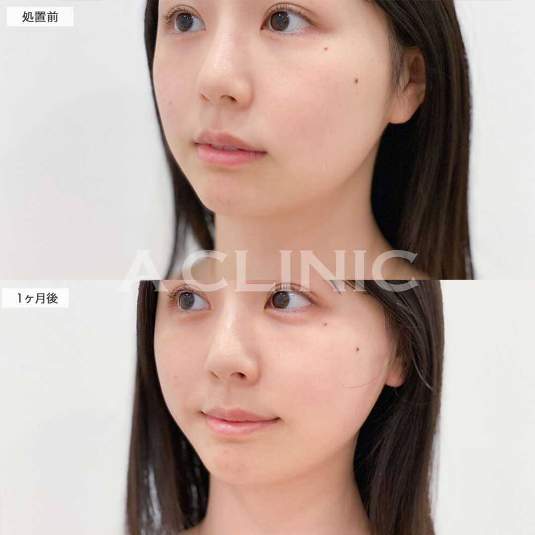 Aスレッドでフェイスライン整えて一気に垢抜け！処置前と直後の症例です(20代女性)