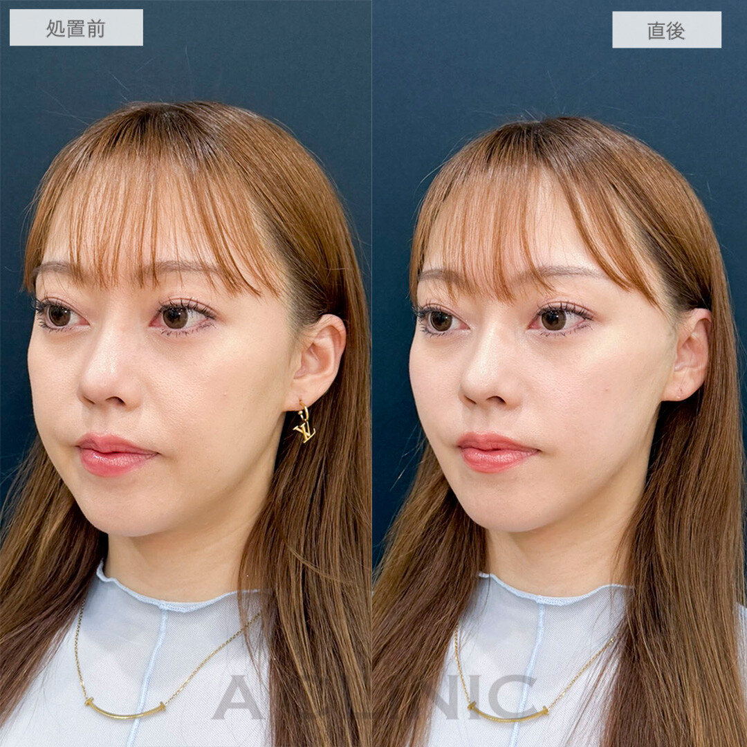 Aスレッドでほうれい線や輪郭のもたつきを解消！処置前と直後の症例です(30代女性)