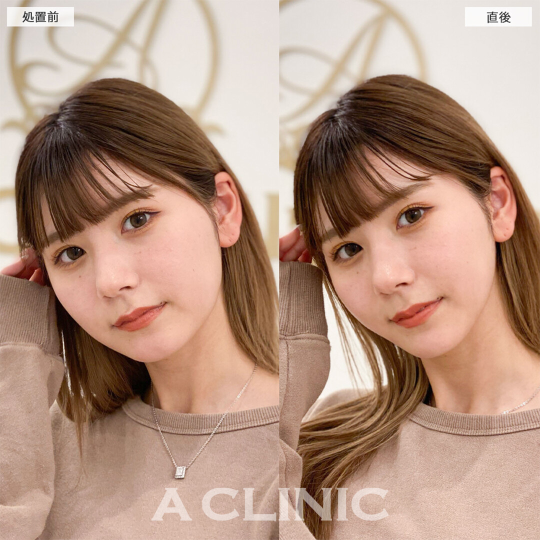 Aスレッドとあごへのヒアルロン酸注入で引き締まった輪郭に！こちら処置前と直後の症例です(20代女性)