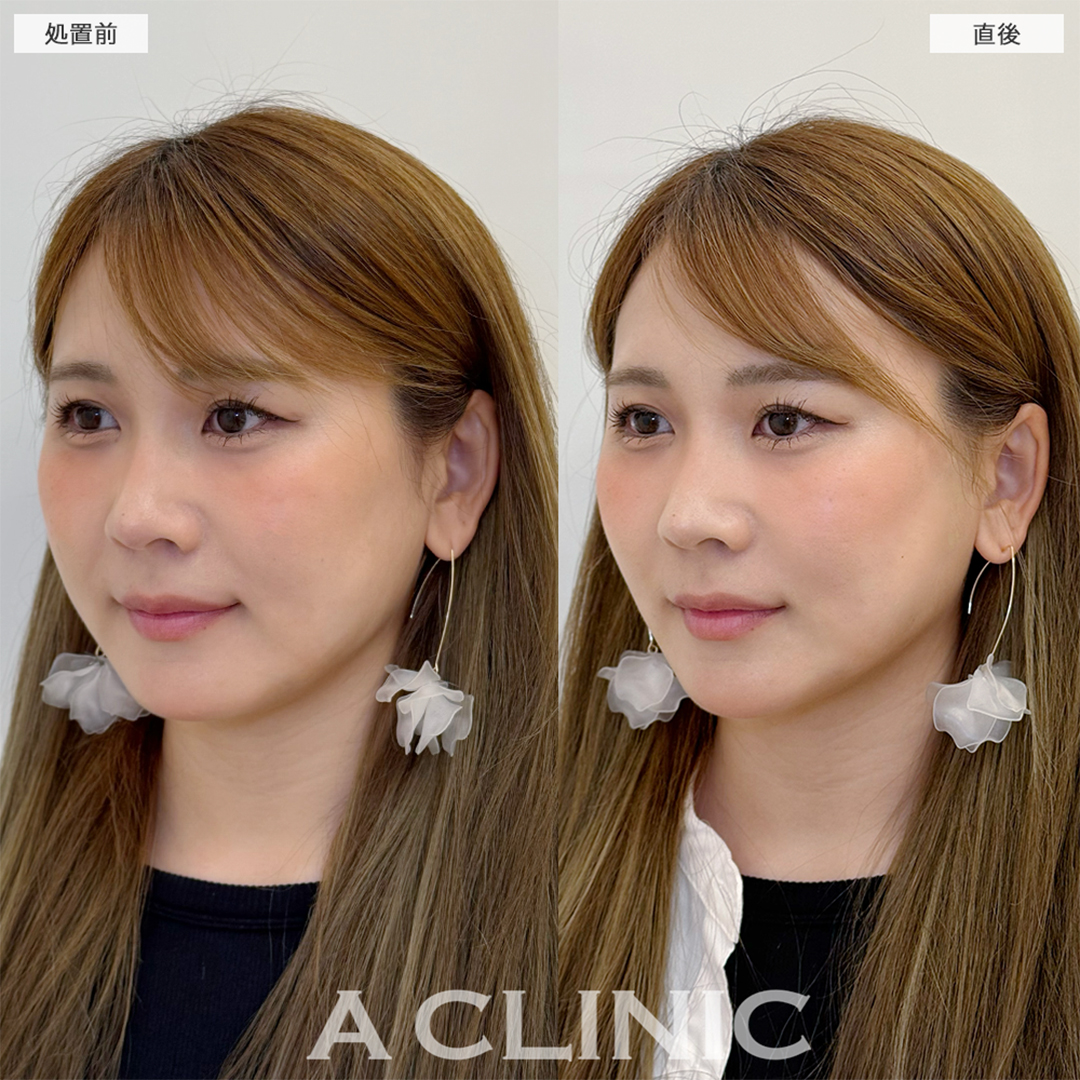 Aスレッドでほうれい線が薄くなり若返りました！こちら処置前と直後の症例です(30代女性)