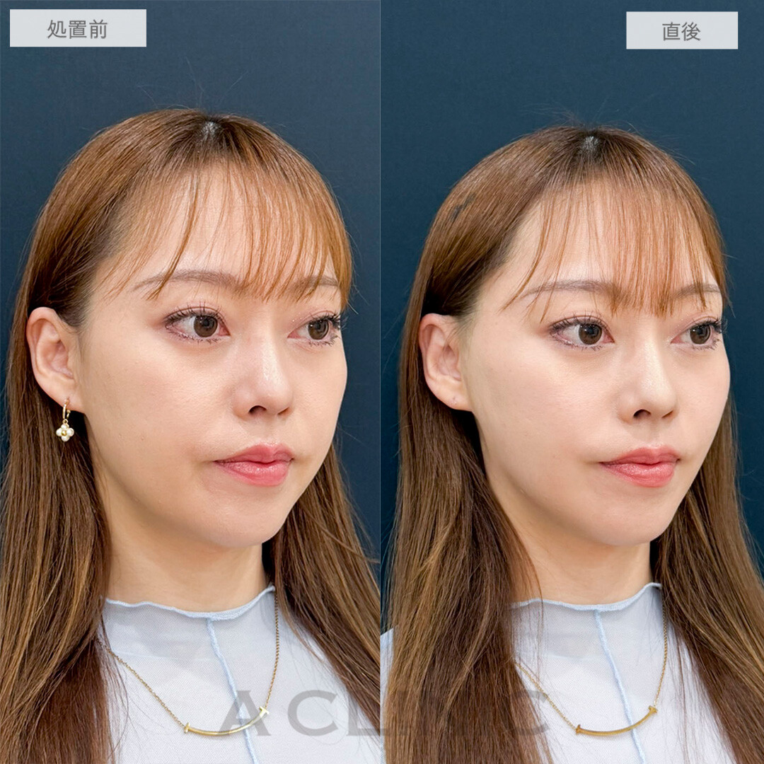 Aスレッドでほうれい線や輪郭のもたつきを解消！処置前と直後の症例です(30代女性)