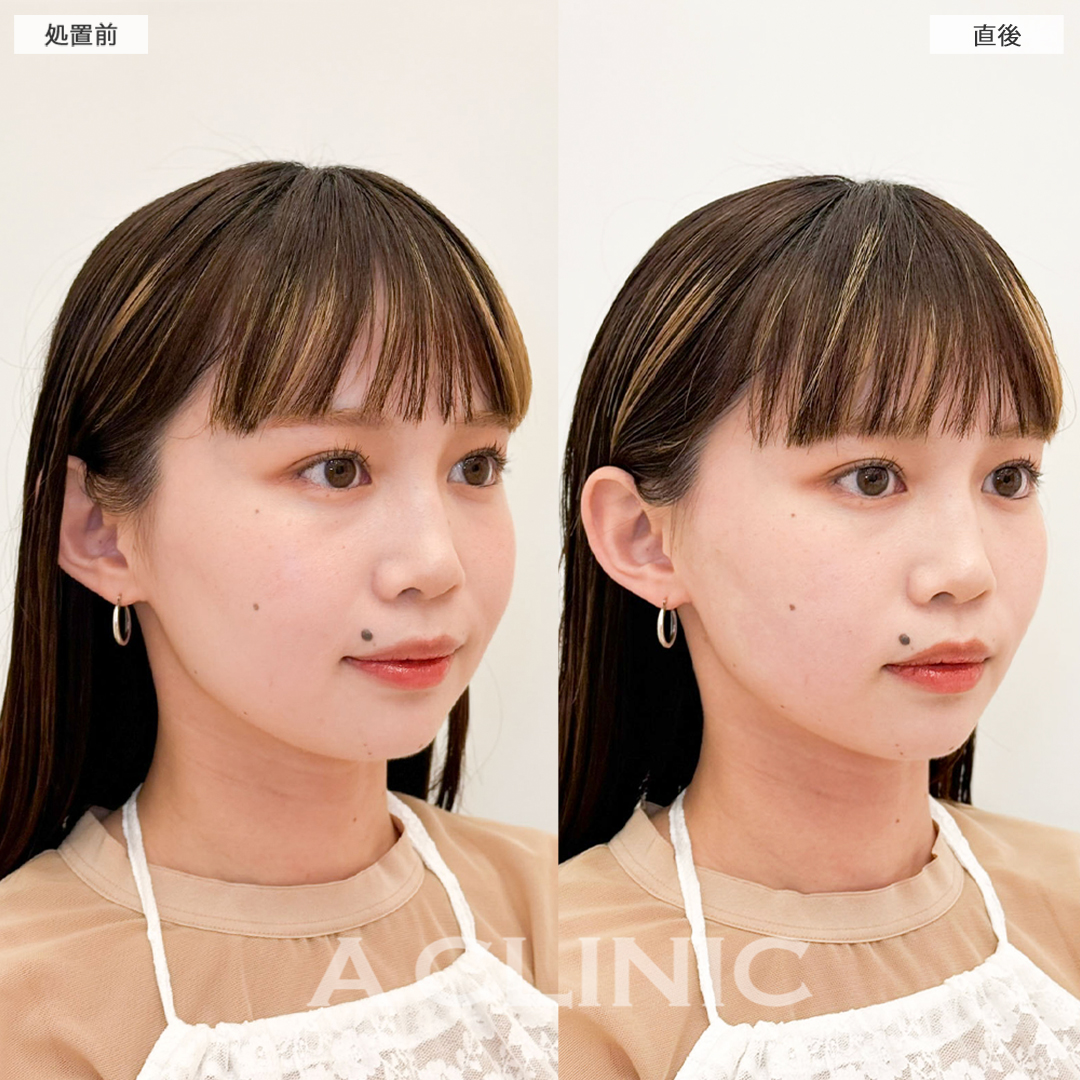 Aスレッドで直後からリフトアップしもっとかわいいお顔に！こちら処置前と直後の症例です(20代女性)