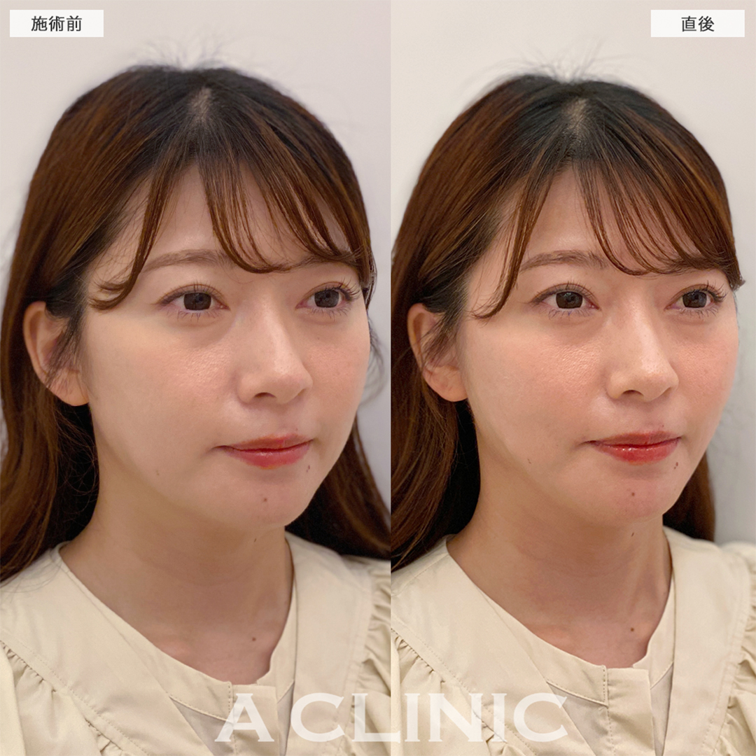 Aスレッドは人中短縮にも効果あり！こちら処置前と直後の症例です(30代女性)