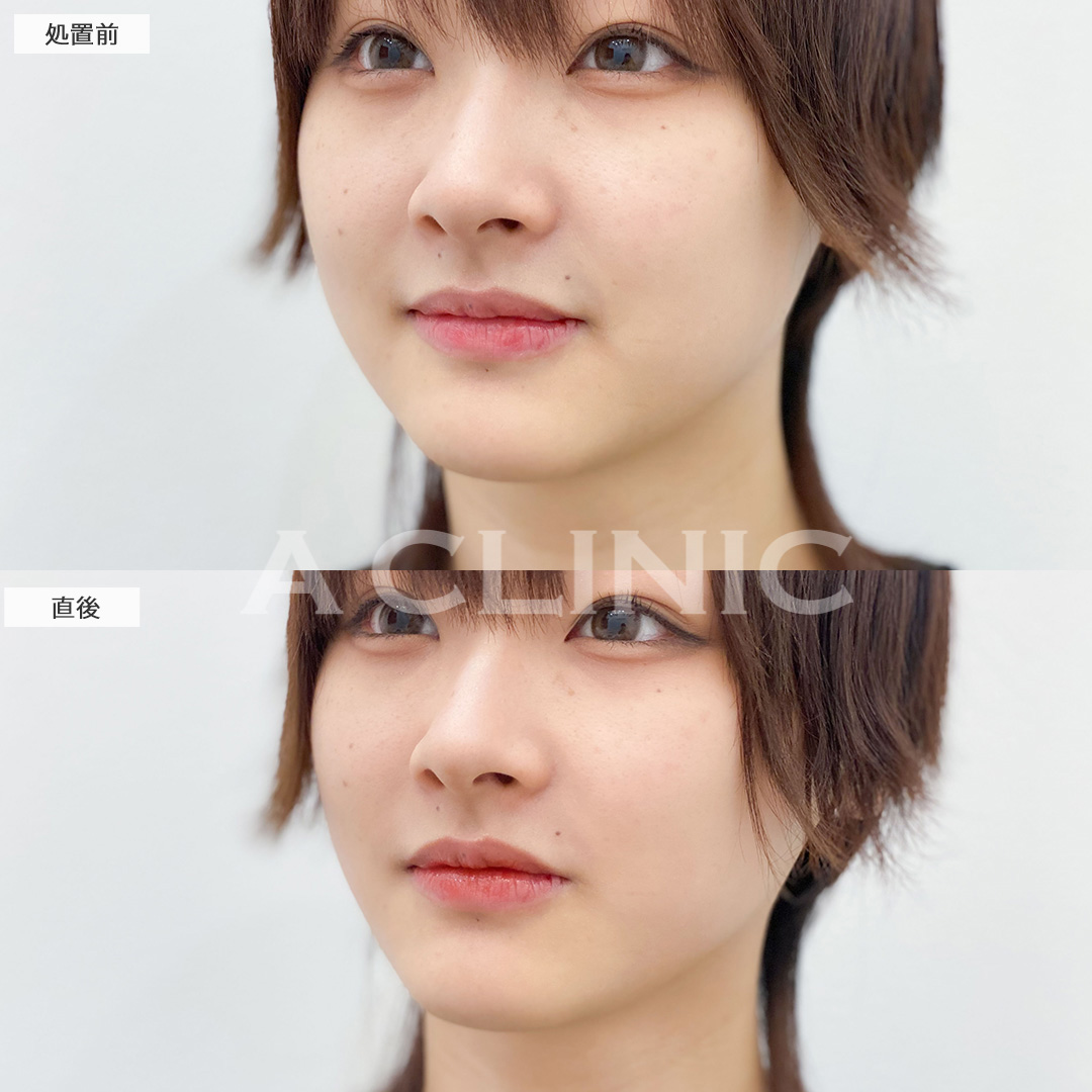Aスレッドで加工アプリ級の小顔に！こちら処置前と直後の症例です(20代女性)