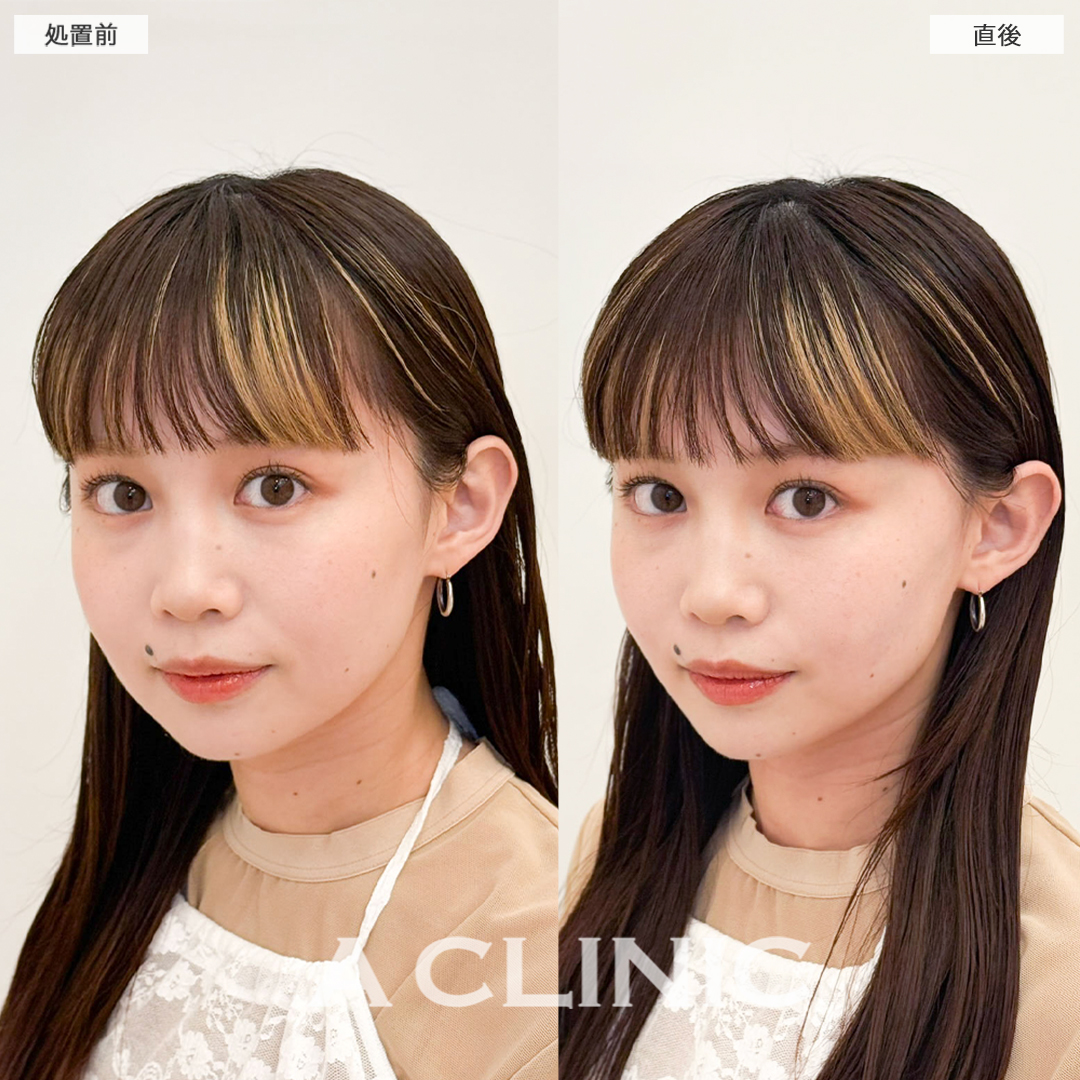 Aスレッドで直後からリフトアップしもっとかわいいお顔に！こちら処置前と直後の症例です(20代女性)