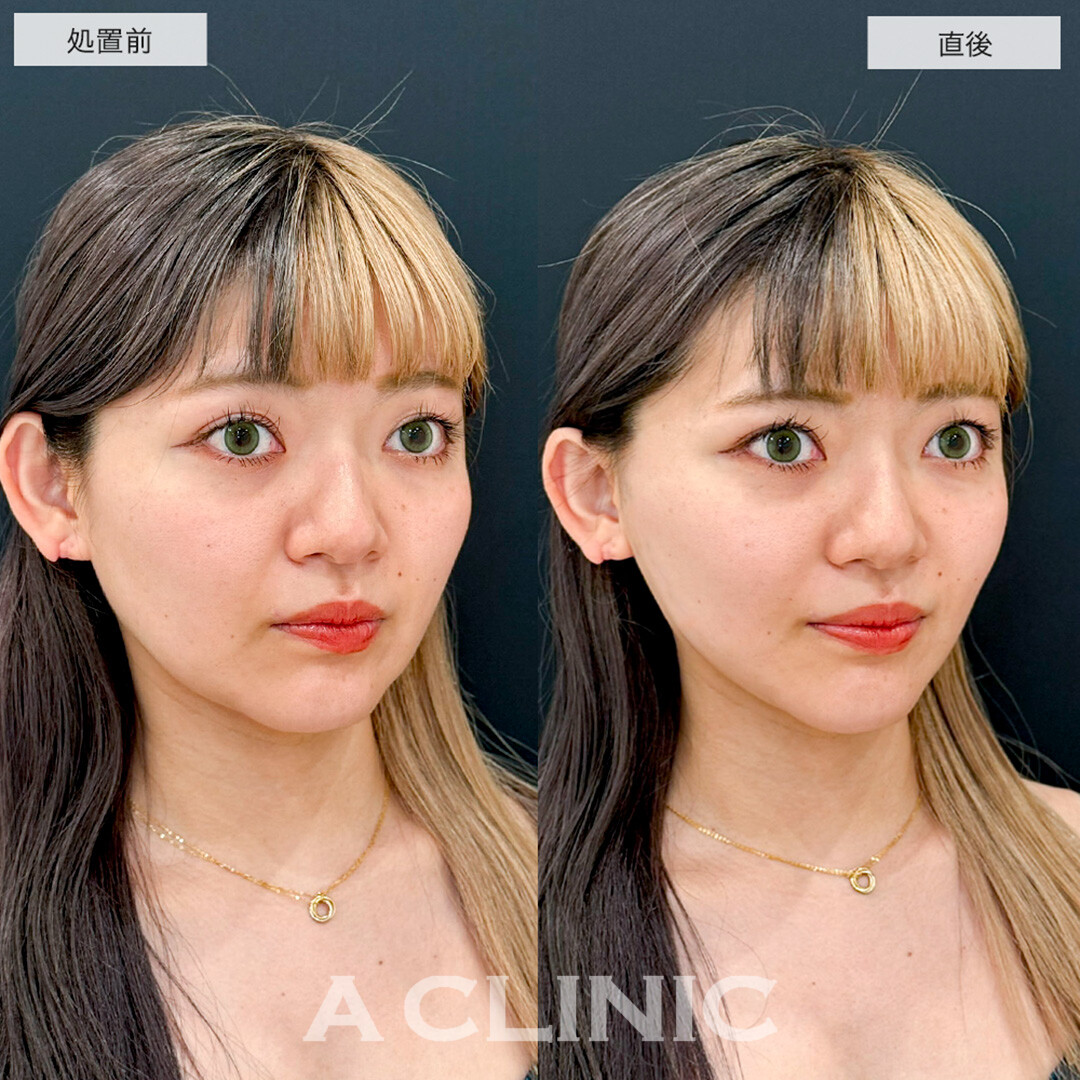 Aスレッドでほうれい線が改善しマイナス5歳若返りました!こちら処置前と直後の症例です(30代女性)