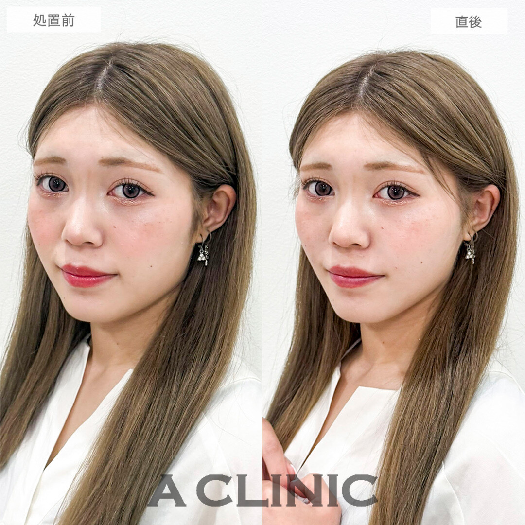 Aスレッドとほうれい線へのヒアルロン酸注入で顔のたるみが解消してV字輪郭になりました！処置前と直後の症例です(20代女性)