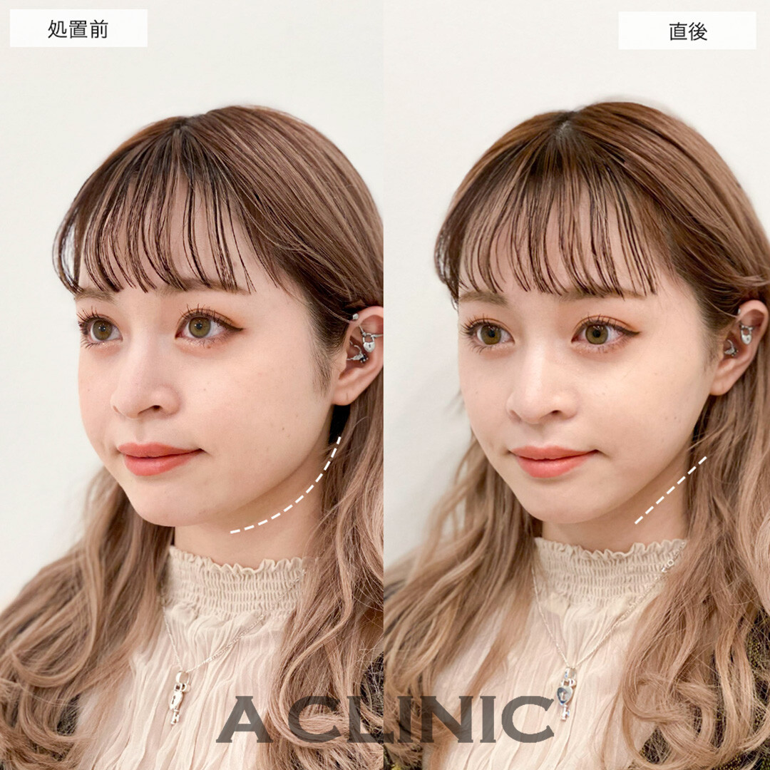 Aスレッドでたるみ解消し垢抜けた印象に!こちら処置前と直後の症例です(20代女性)