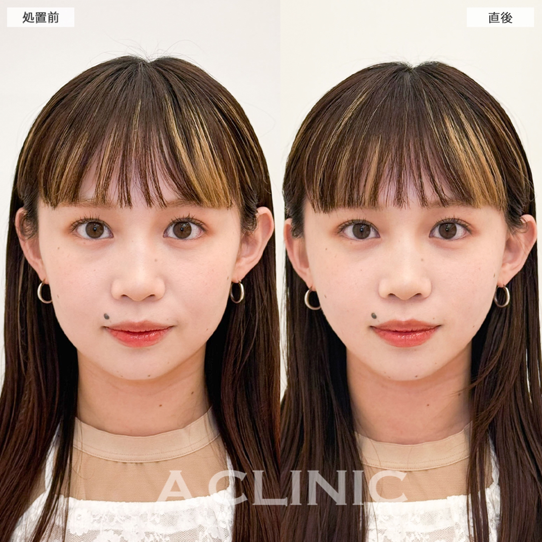 Aスレッドで直後からリフトアップしもっとかわいいお顔に！こちら処置前と直後の症例です(20代女性)