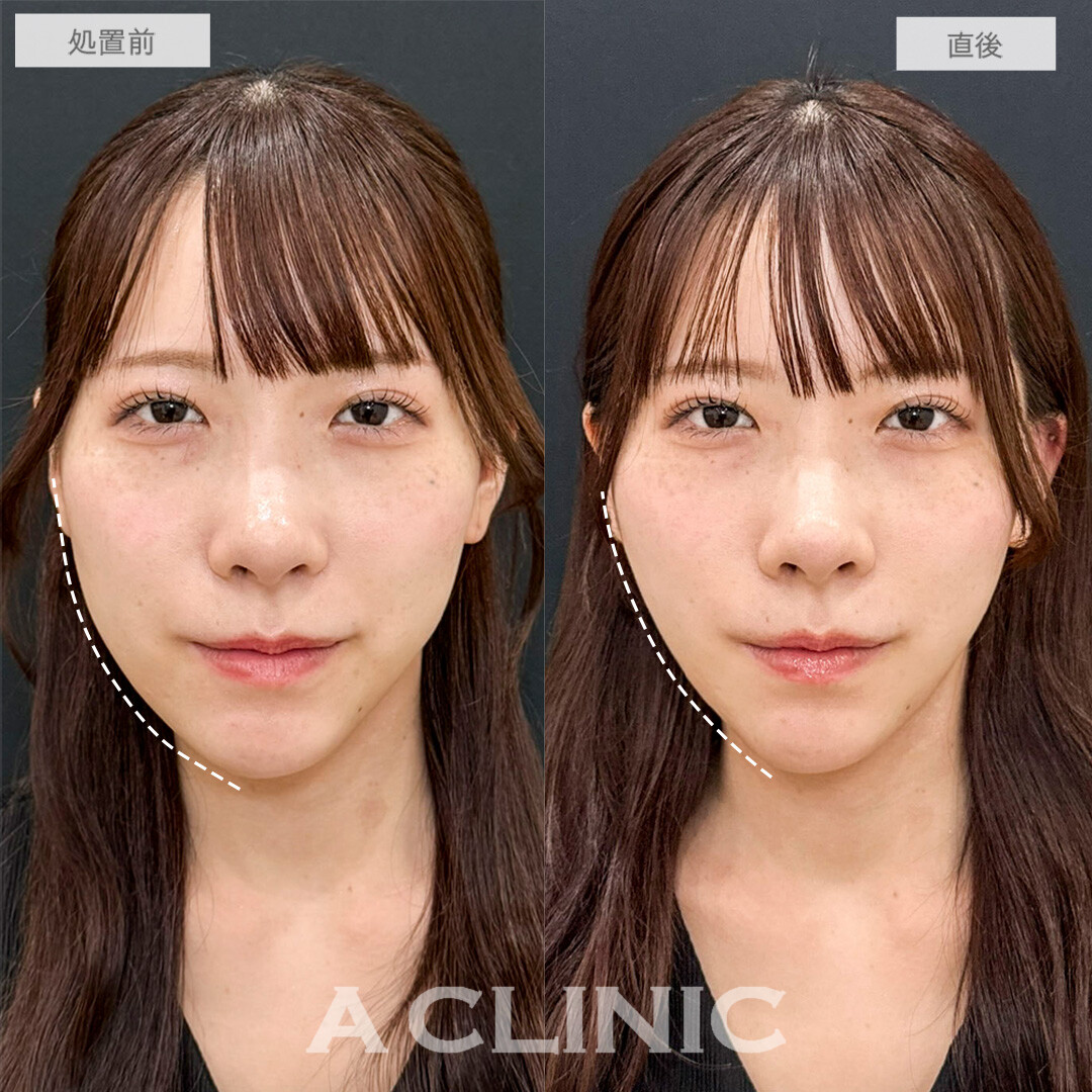Aスレッドで輪郭の左右差が改善しました！処置前と直後の症例です(20代女性)