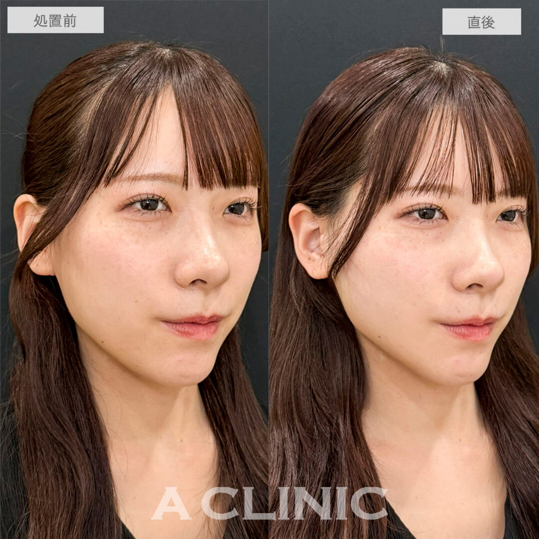 Aスレッドで輪郭の左右差が改善しました！処置前と直後の症例です(20代女性)