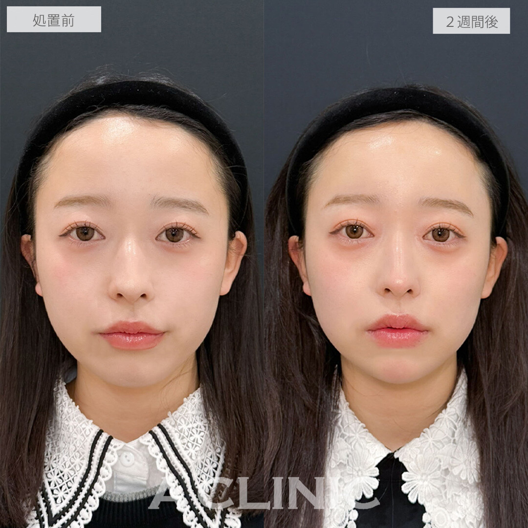 ヒアルロン酸カスタマイズメニューで自然な立体感を出して更に可愛くなれちゃいます！こちら処置前と2週間後の症例です(20代女性)