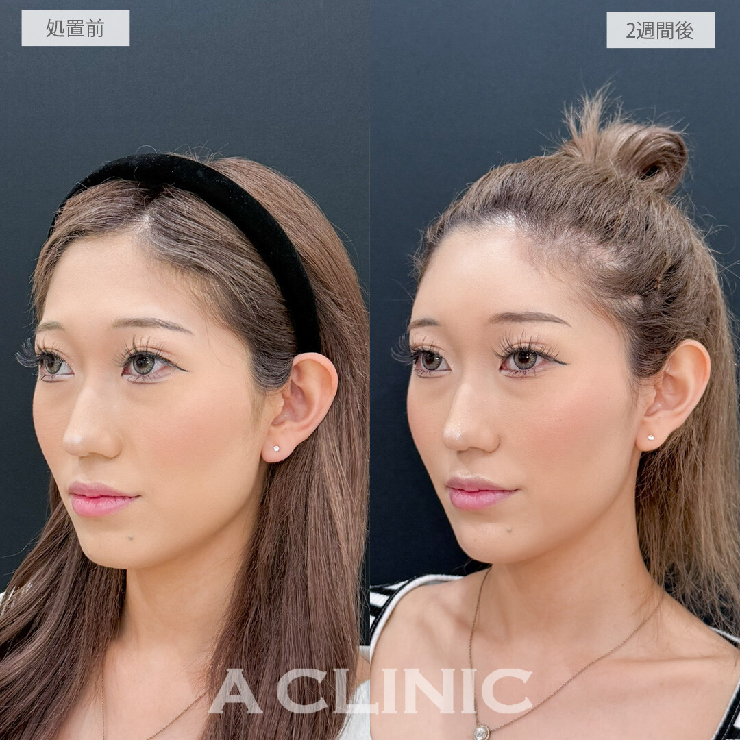 ヒアルロン酸カスタマイズメニューで平面をなくしはっきりした顔立ちへ！処置前と2週間後の症例です(20代女性)