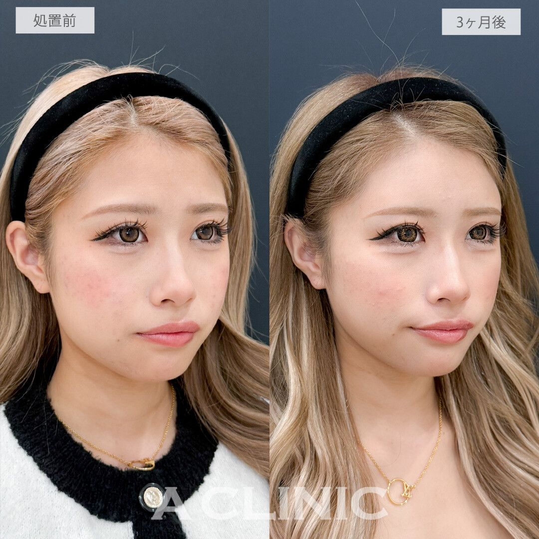 ヒアルロン酸カスタマイズメニューで立体感を出しつつ輪郭も整う！処置前と3ヶ月後の症例です(20代女性)