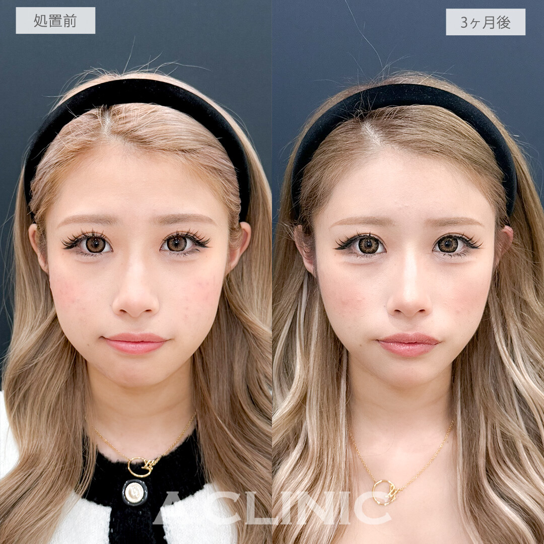 ヒアルロン酸カスタマイズメニューで立体感を出しつつ輪郭も整う！処置前と3ヶ月後の症例です(20代女性)