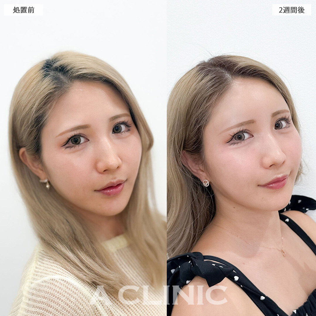 ヒアルロン酸カスタマイズメニューで凹みを軽減させて柔らかい雰囲気になりました！こちら処置前と2週間後の症例です(30代女性)