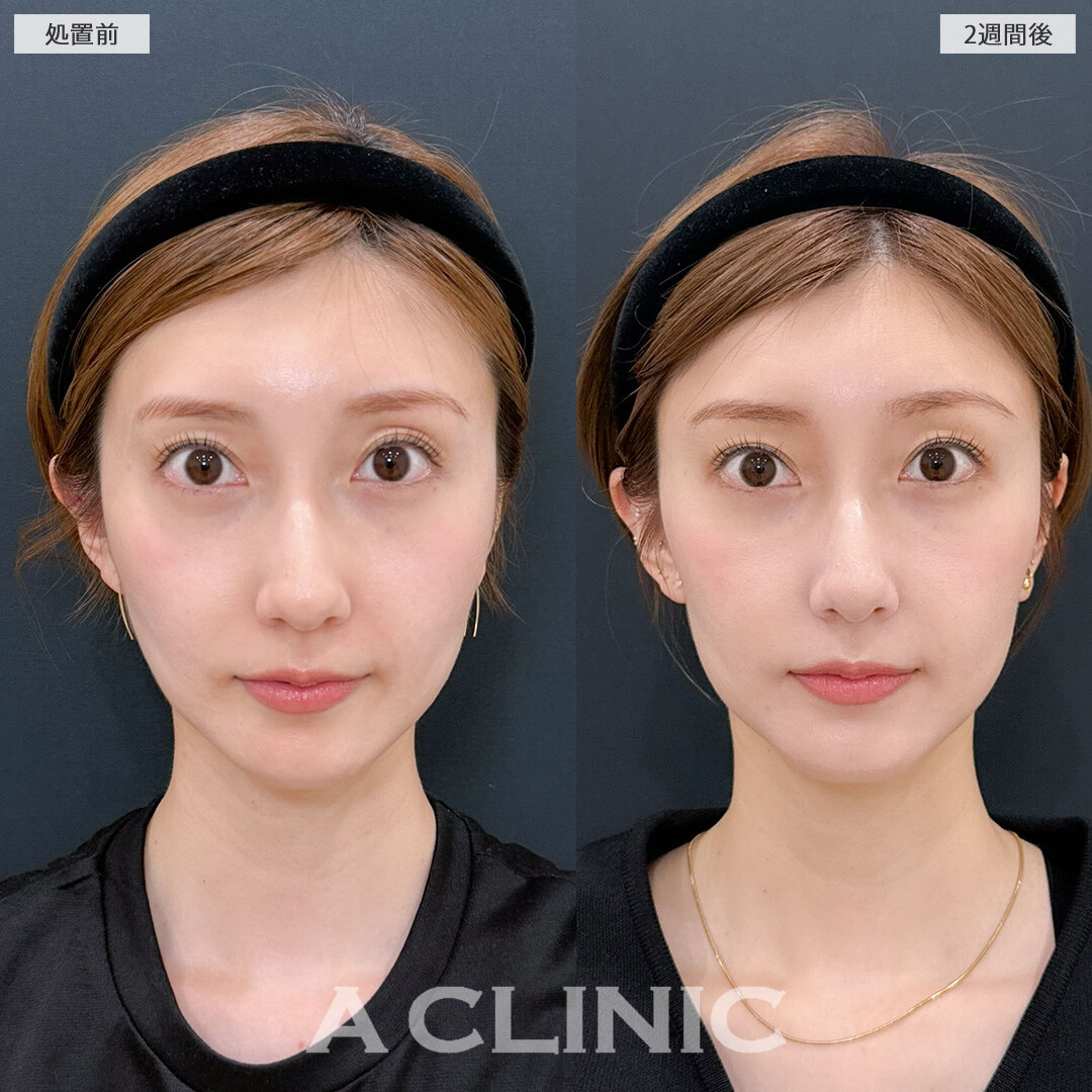 ヒアルロン酸カスタマイズメニューででお顔の凹みを整え一気に若返りました！こちら処置前と2週間後の症例です(30代女性)