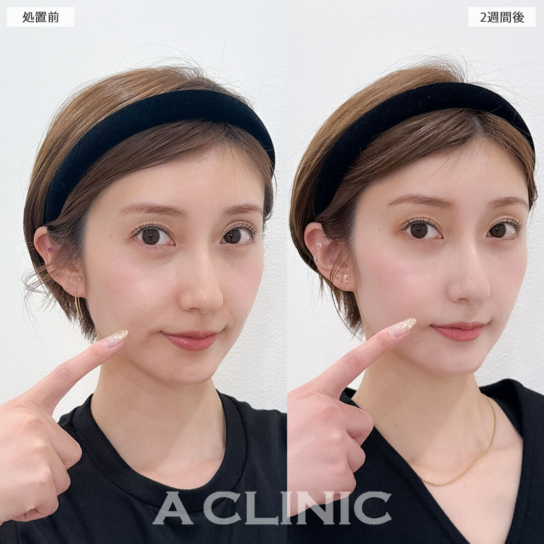 ヒアルロン酸カスタマイズメニューででお顔の凹みを整え一気に若返りました！こちら処置前と2週間後の症例です(30代女性)