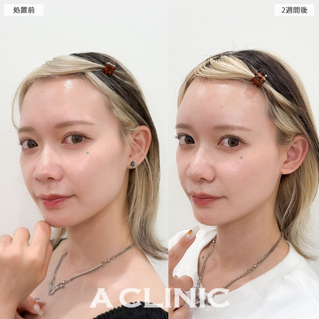ヒアルロン酸カスタマイズメニューでお顔がより立体的に可愛くなりました！こちら処置前と2週間後の症例です(20代女性)