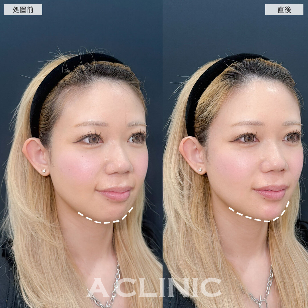 ヒアルロン酸カスタマイズメニューとボトックス注射だけでこんなにスッキリVフェイスが作れます！こちら処置前と直後の症例です(30代女性)