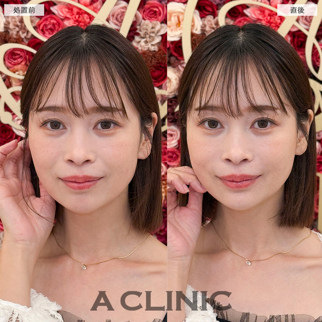 ヒアルロン酸カスタマイズメニューで自然にコンプレックス解消！処置前と直後の症例です(30代女性)