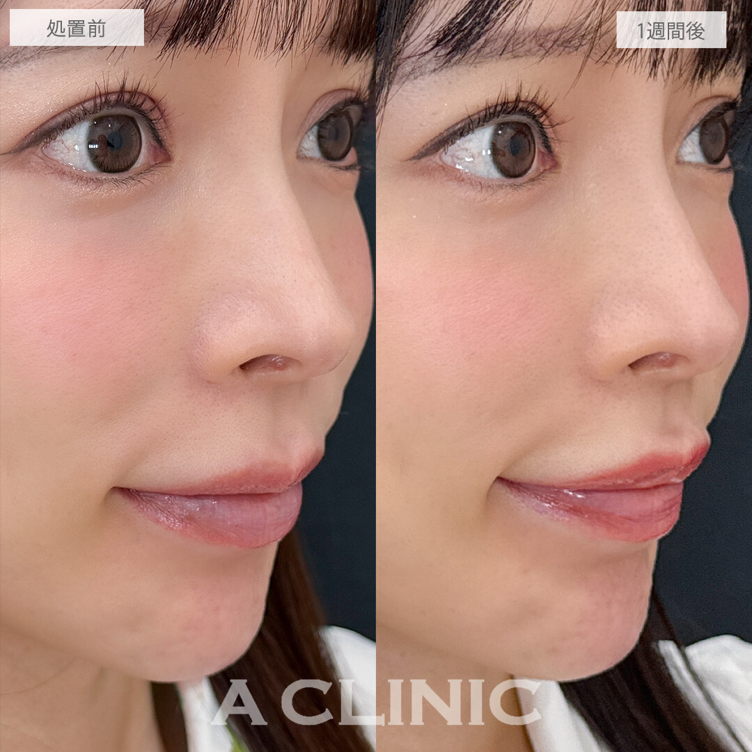 お顔のバランスが整って中顔面がぎゅっと短縮されました！こちら切らない人中短縮の処置前と1週間後の症例です(30代女性)