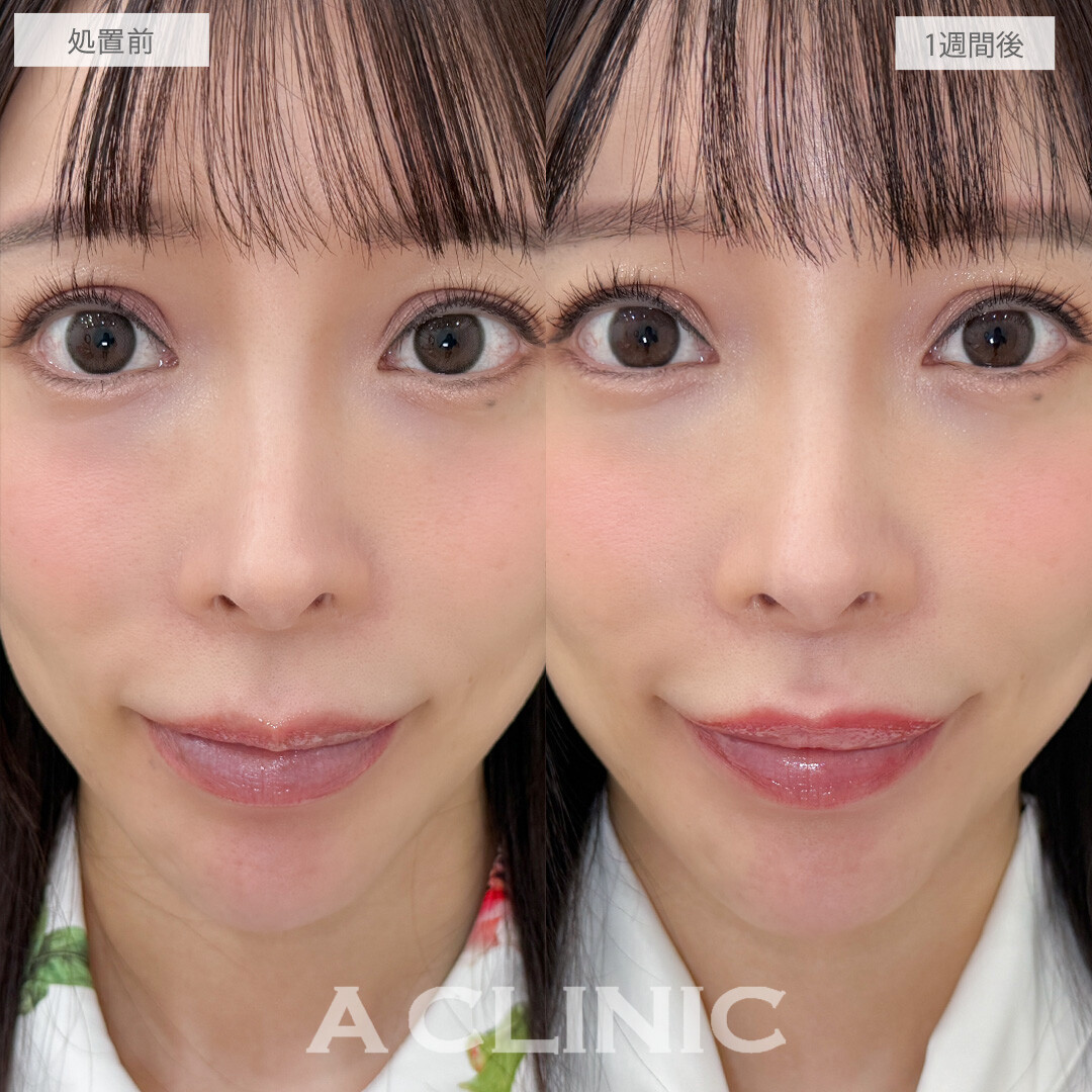 お顔のバランスが整って中顔面がぎゅっと短縮されました！こちら切らない人中短縮の処置前と1週間後の症例です(30代女性)