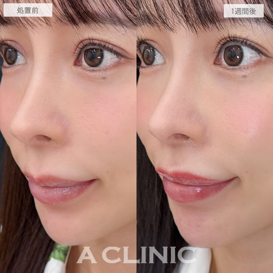 お顔のバランスが整って中顔面がぎゅっと短縮されました！こちら切らない人中短縮の処置前と1週間後の症例です(30代女性)