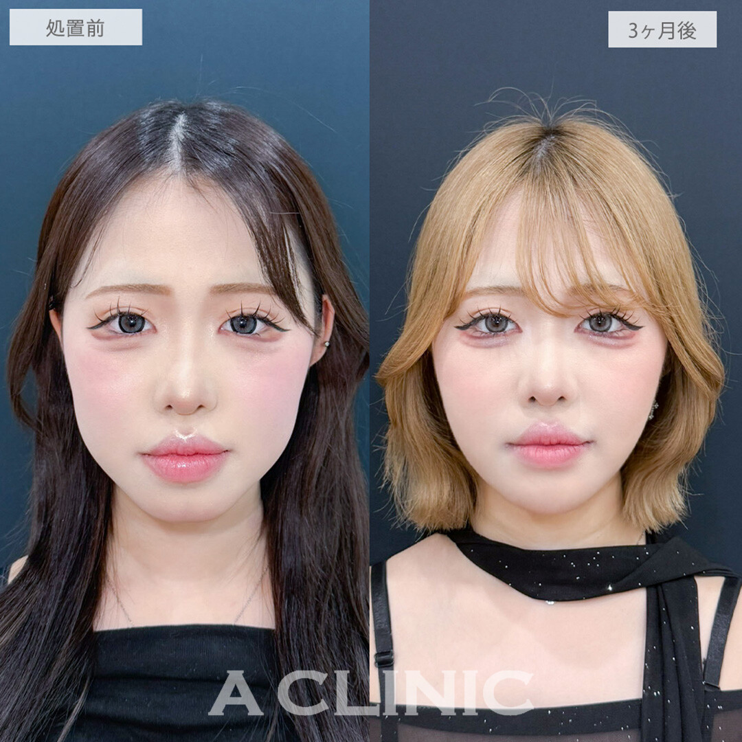 1day小顔脂肪吸引とあごへのヒアルロン酸注入とあごのボトックス注射で加工いらずのVフェイスに！こちら処置前と3ヶ月後の症例です(10代女性)