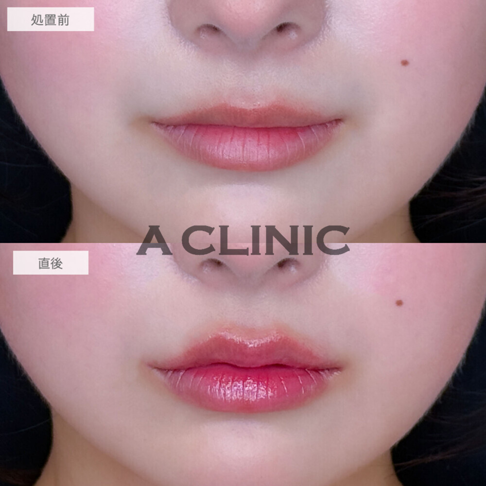 スマイルリップでナチュラルに唇のボリュームアップが叶います！こちら処置前と直後の症例です(20代女性)
