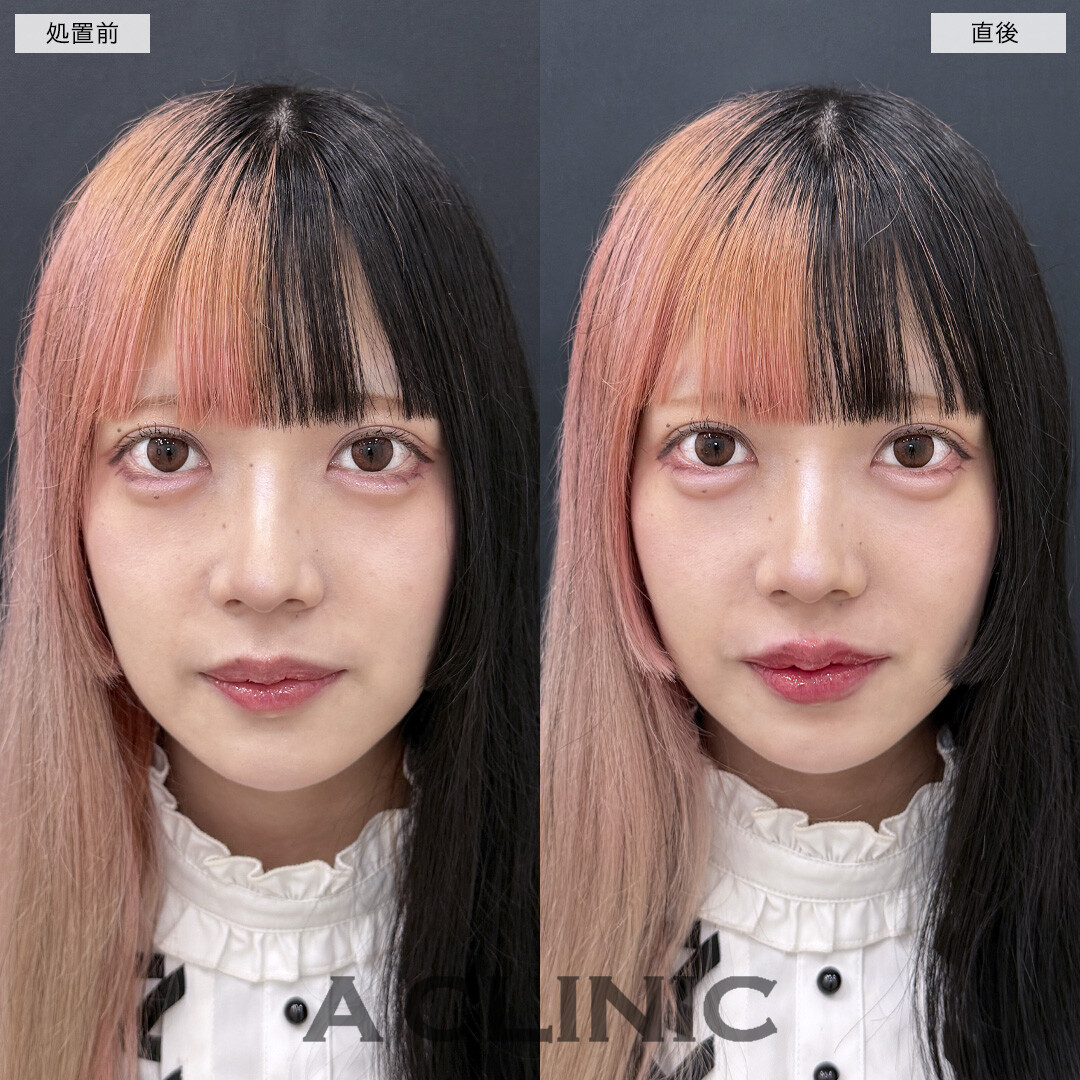 涙袋形成術(ヒアルロン酸)とリップヒアルロン酸注入で今っぽフェイスに！処置前と直後の症例です(20代女性)