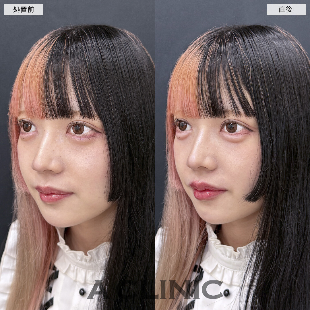 涙袋形成術(ヒアルロン酸)とリップヒアルロン酸注入で今っぽフェイスに！処置前と直後の症例です(20代女性)