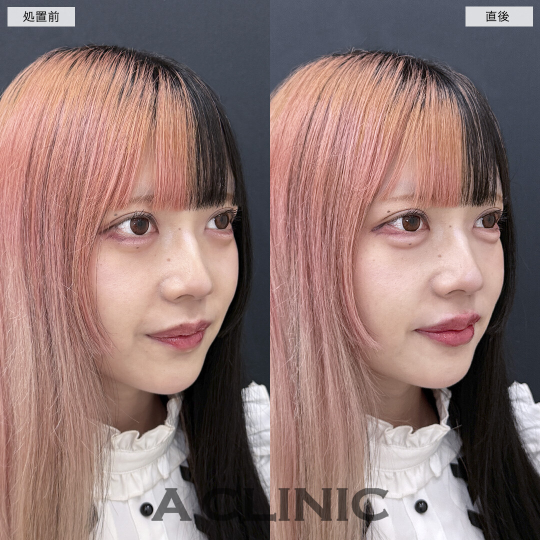 涙袋形成術(ヒアルロン酸)とリップヒアルロン酸注入で今っぽフェイスに！処置前と直後の症例です(20代女性)