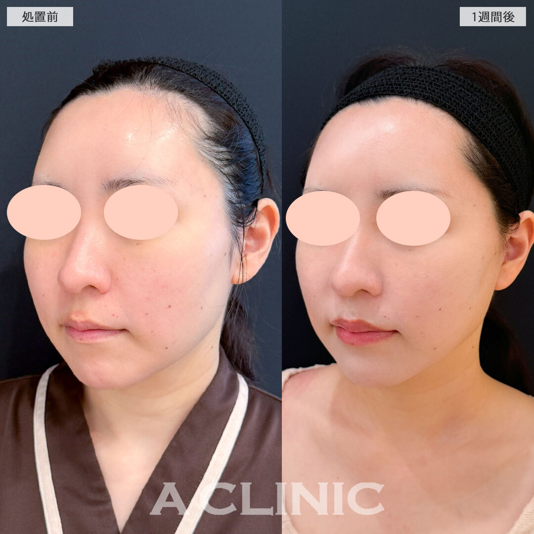 A式美肌たるみ切開で気になる口横のもたつきを解消！こちら処置前と1週間後の症例です(30代女性)