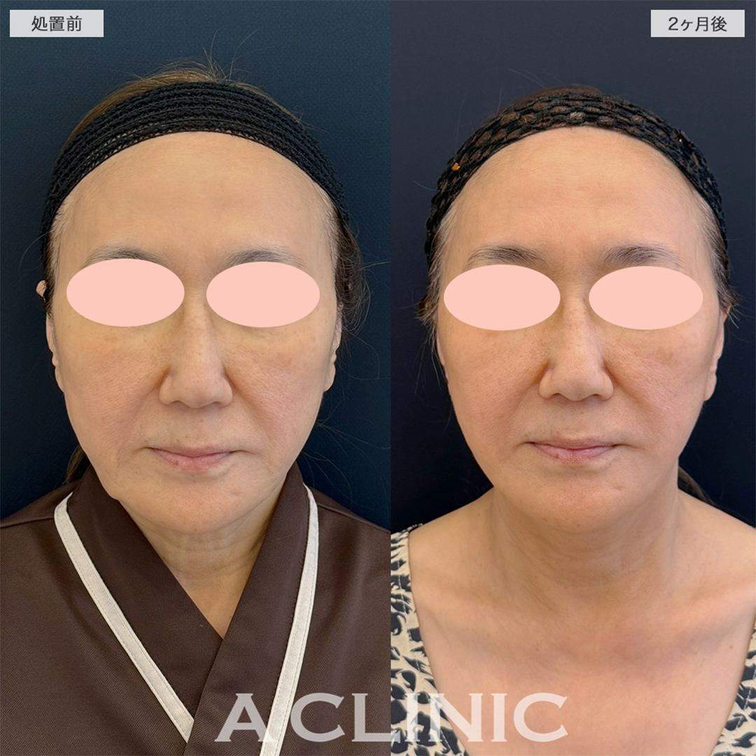 A式美肌たるみ切開で長年の悩みが解消されました！こちら処置前と2ヶ月後の症例です(60代女性)