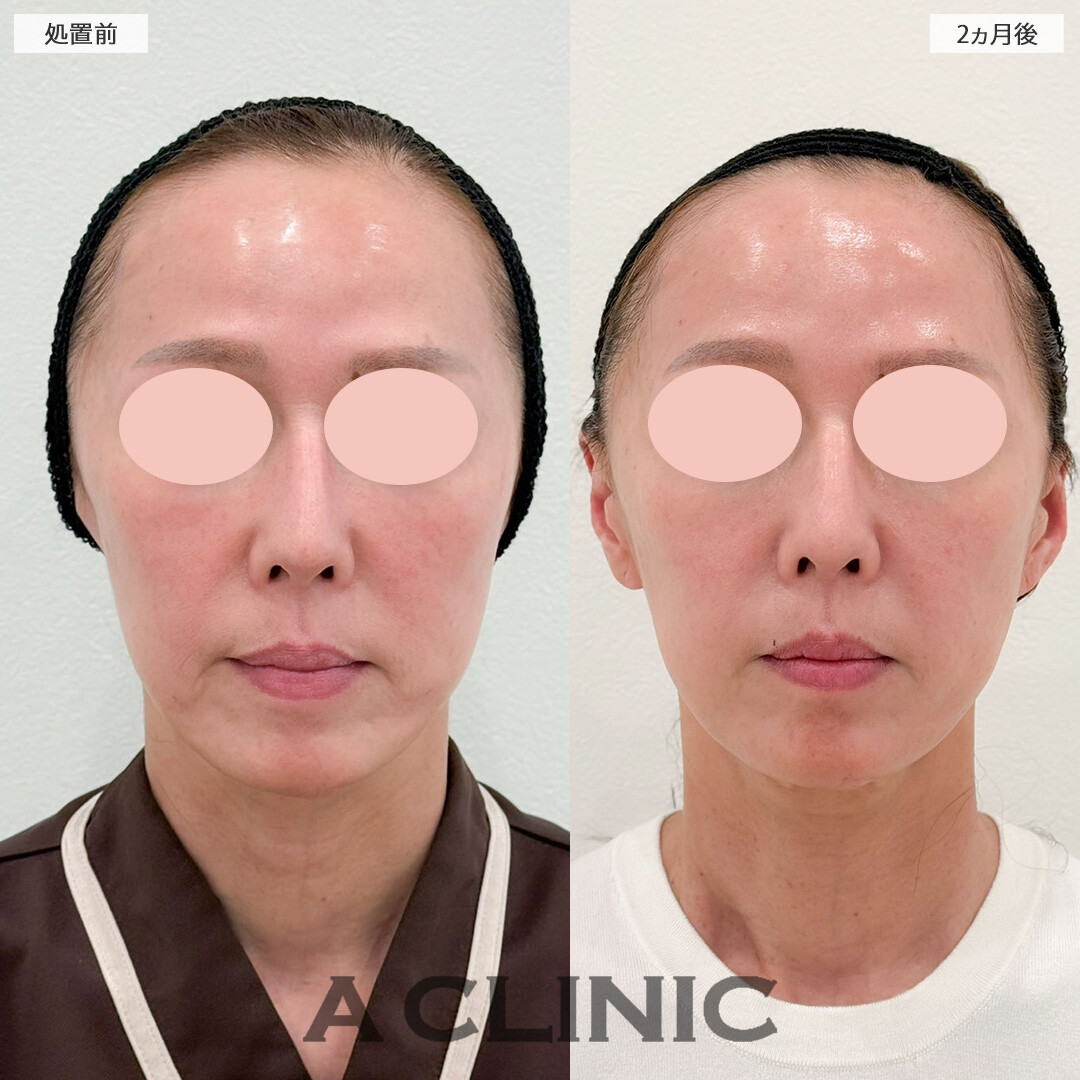 【直後の傷跡あり】A式美肌たるみ切開で圧倒的に若返り大成功！こちら処置前後と2ヵ月後の症例です(50代女性)