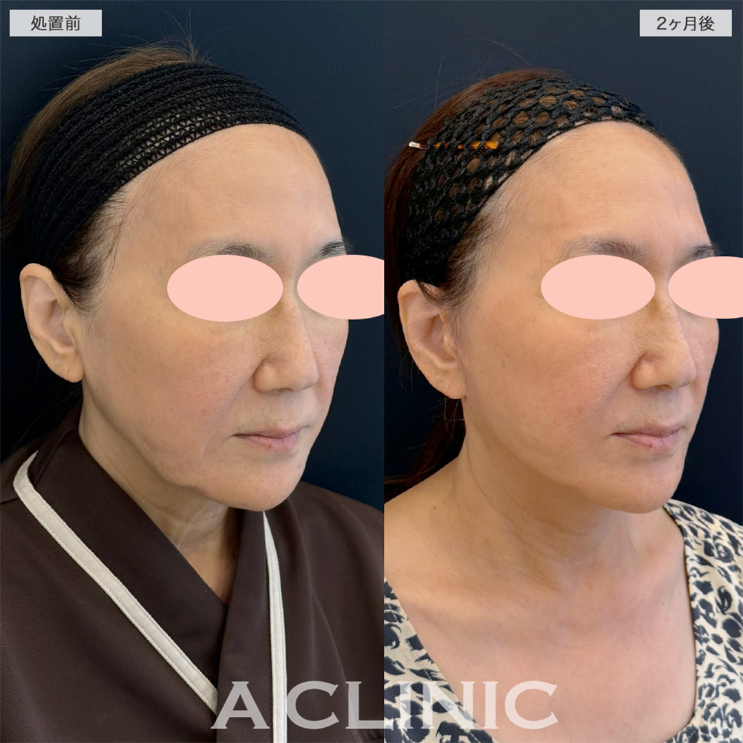 A式美肌たるみ切開で長年の悩みが解消されました！こちら処置前と2ヶ月後の症例です(60代女性)