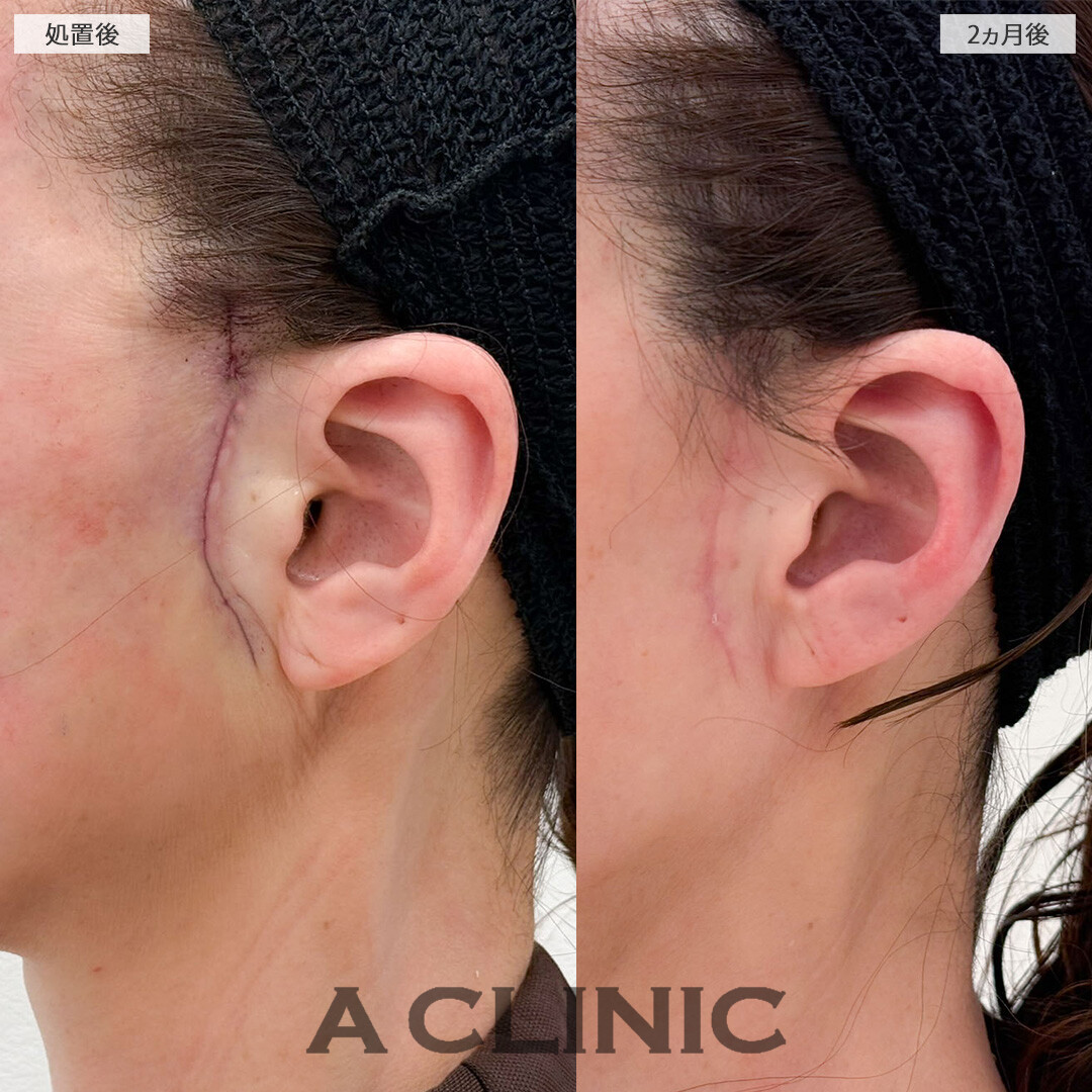 【直後の傷跡あり】A式美肌たるみ切開で圧倒的に若返り大成功！こちら処置前後と2ヵ月後の症例です(50代女性)