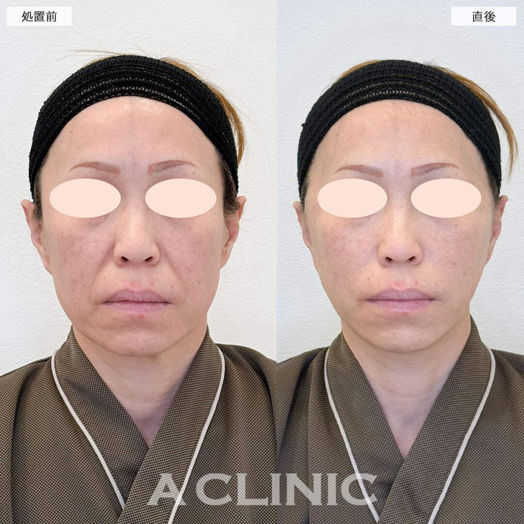 A式美肌たるみ切開でほうれい線改善しました！こちら処置前と直後の症例です(40代女性)