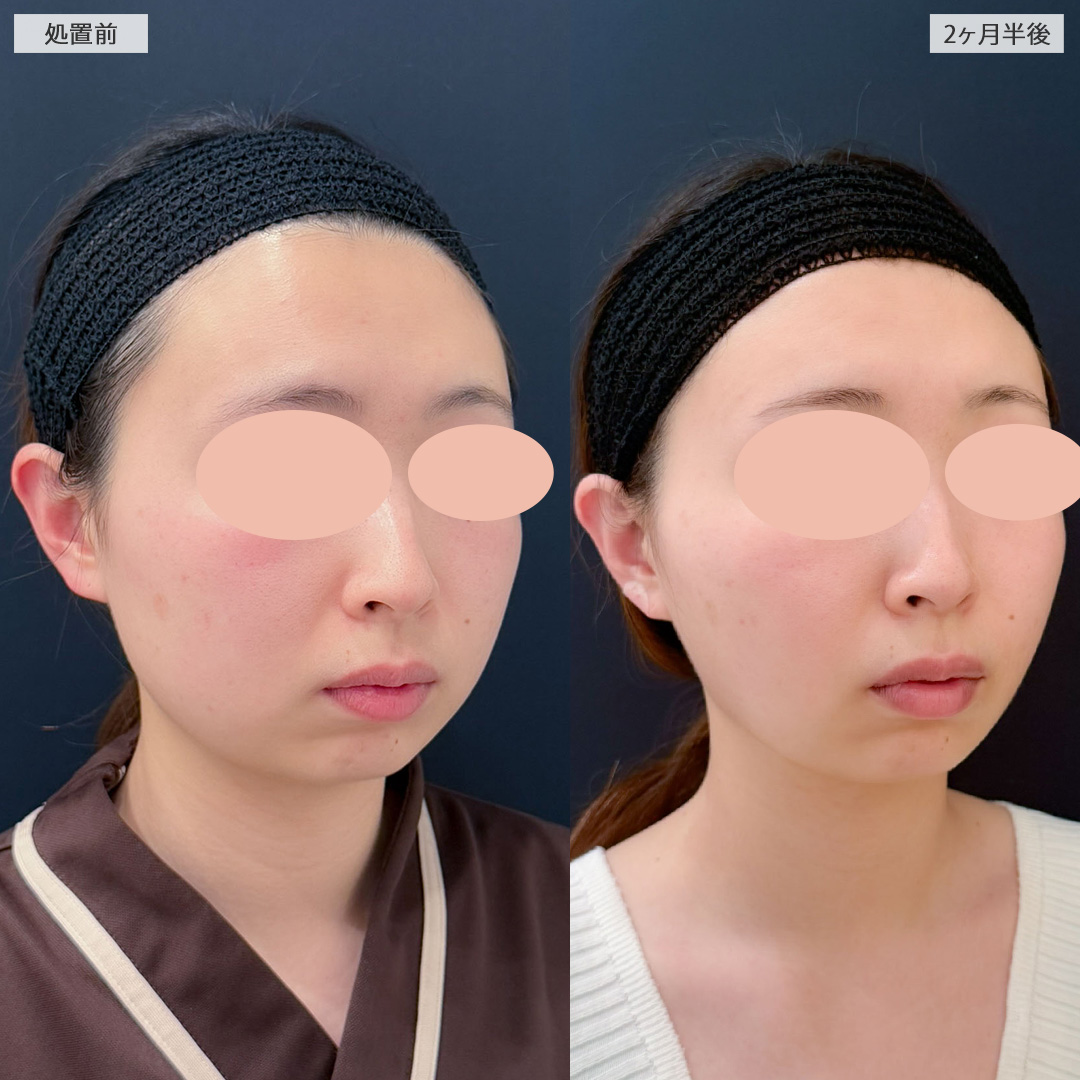 1day小顔はナチュラルに小顔になれる施術です！こちら処置前と2ヶ月半後の症例です(20代女性)