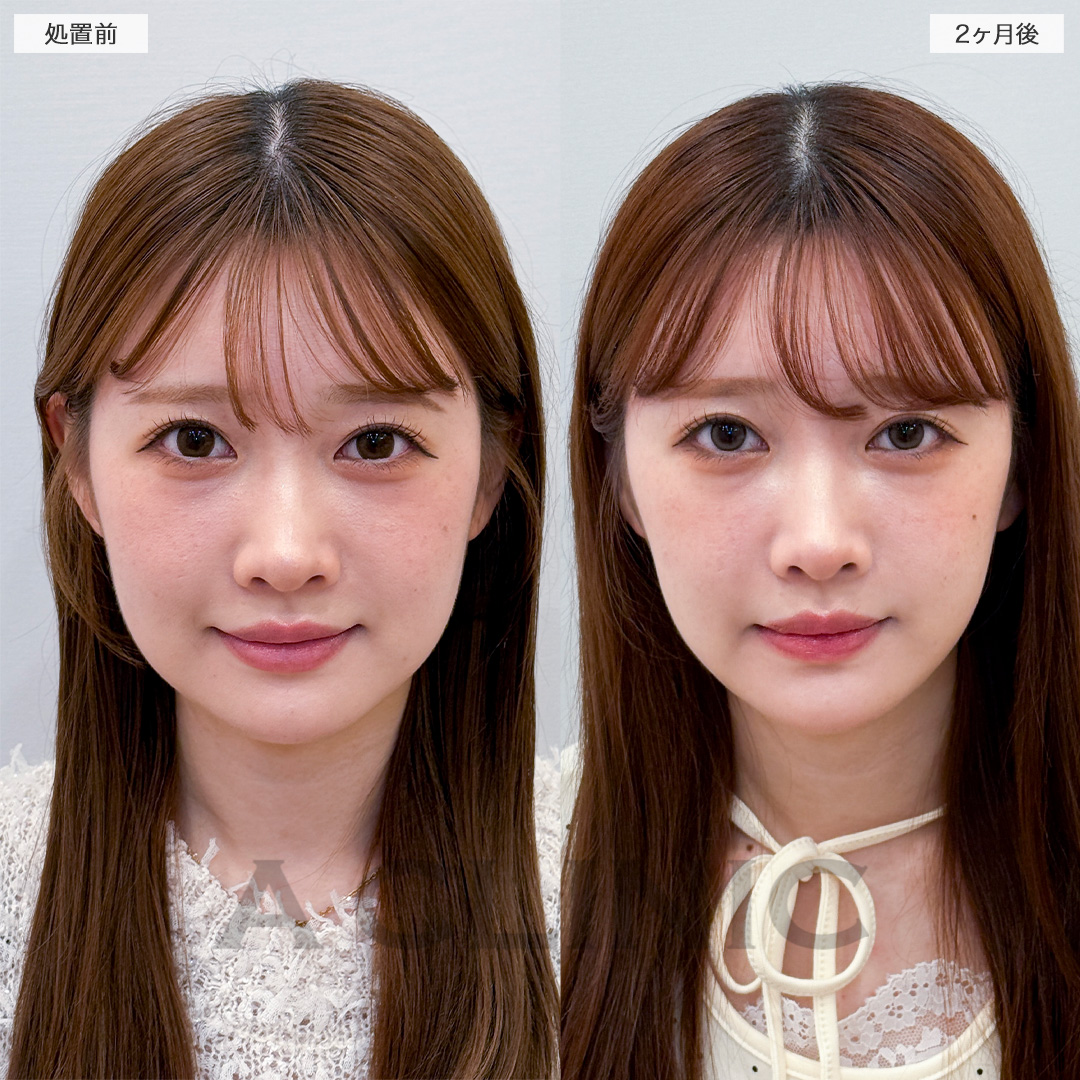 1day小顔脂肪吸引で余分な脂肪がなくなりスッキリ顔痩せ！処置前と2ヶ月後の症例です(20代女性)