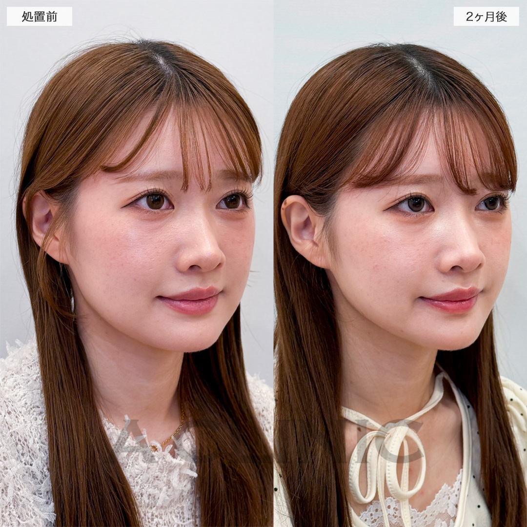 1day小顔脂肪吸引で余分な脂肪がなくなりスッキリ顔痩せ！処置前と2ヶ月後の症例です(20代女性)