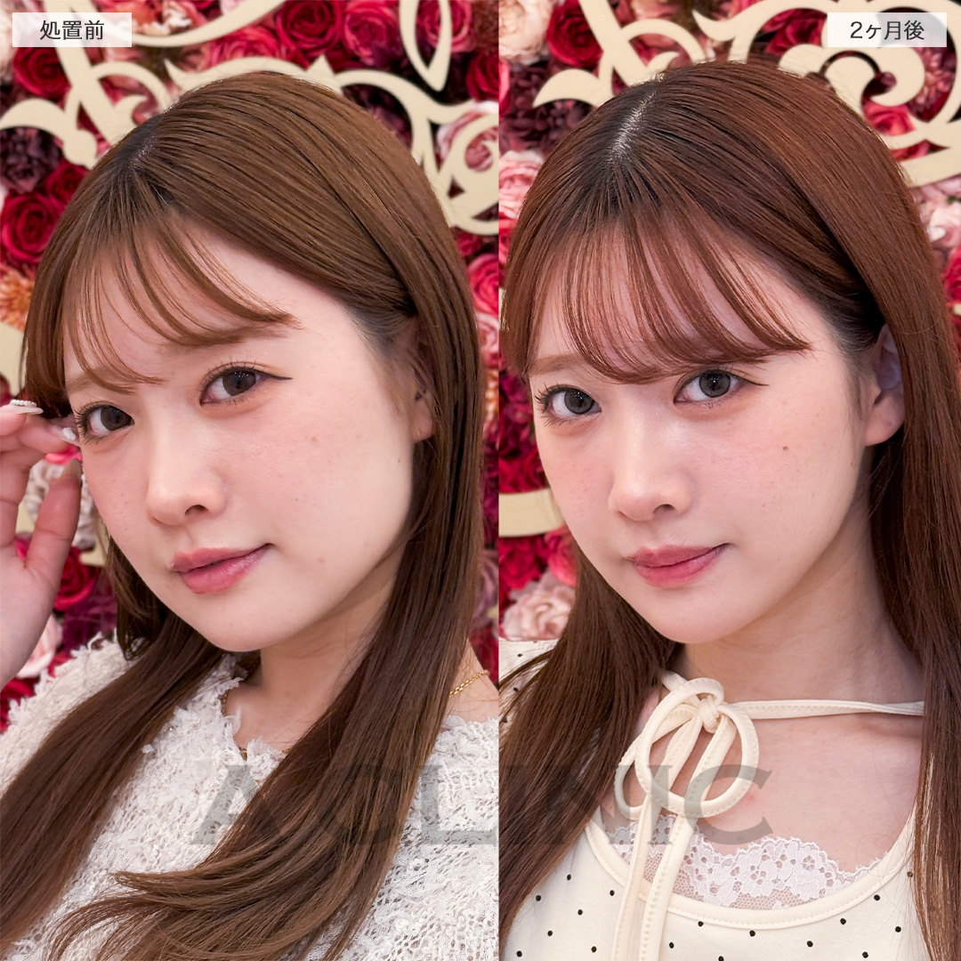 1day小顔脂肪吸引で余分な脂肪がなくなりスッキリ顔痩せ！処置前と2ヶ月後の症例です(20代女性)