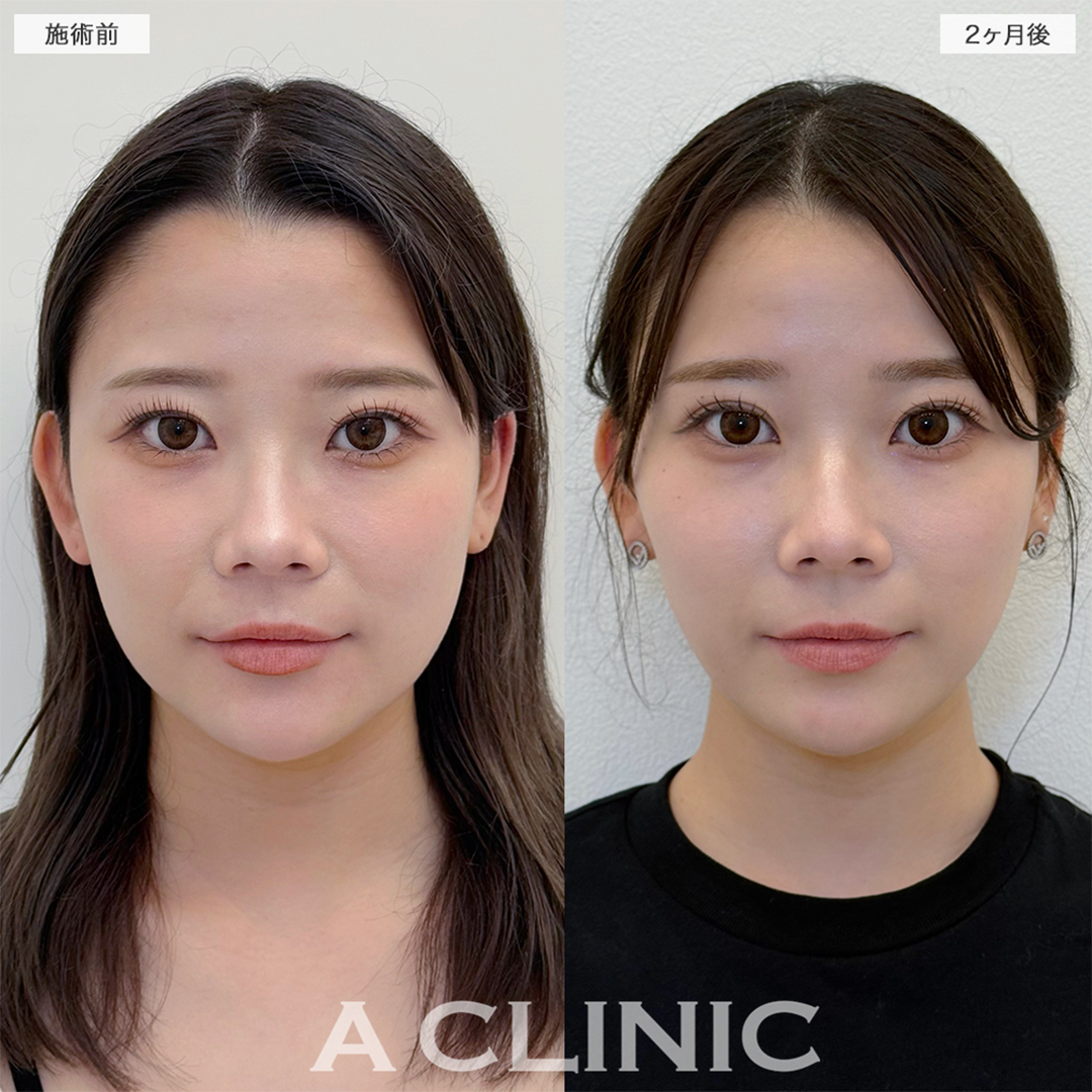 1day小顔脂肪吸引でノーマルカメラも怖くなくなりました！こちら処置前と2ヶ月後の症例です(20代女性)