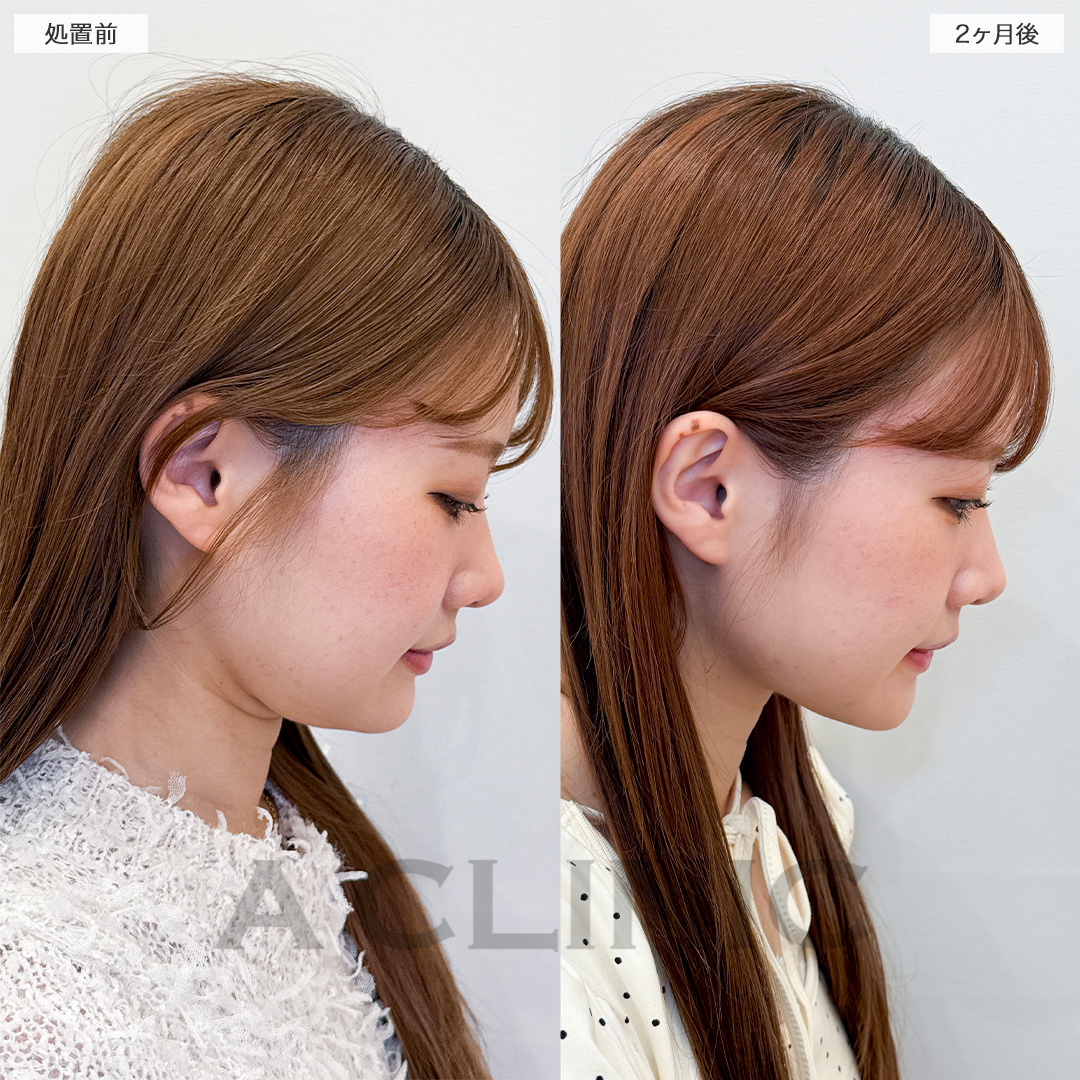 1day小顔脂肪吸引で余分な脂肪がなくなりスッキリ顔痩せ！処置前と2ヶ月後の症例です(20代女性)