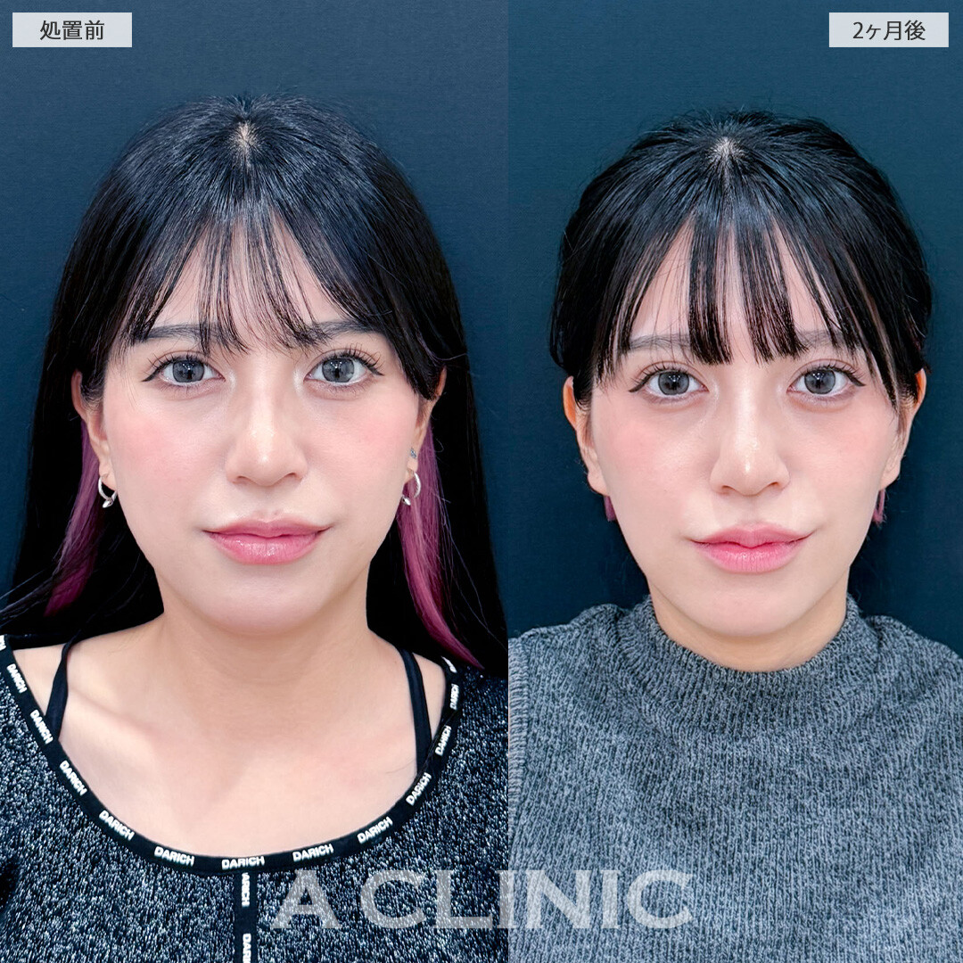 1day小顔脂肪吸引と小顔エラボトックスでフェイスラインのもたつきを解消しシュッとしたフェイスラインに！こちら処置前と2ヶ月後の症例です(20代女性)