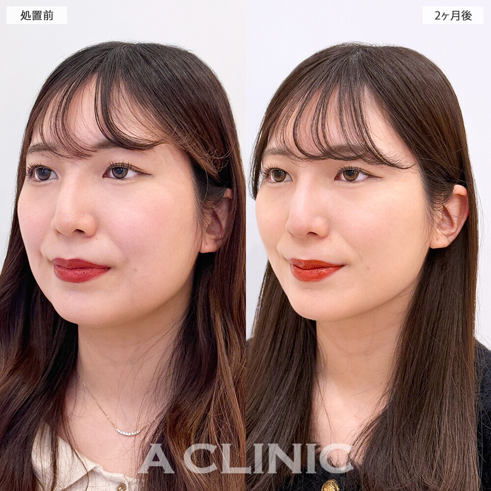 1day小顔脂肪吸引で他撮りも盛れる小顔に！こちら処置前と2ヶ月後の症例です(20代女性)